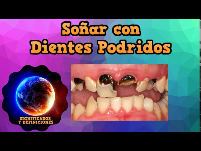 sonar con los dientes podridos o picados 1